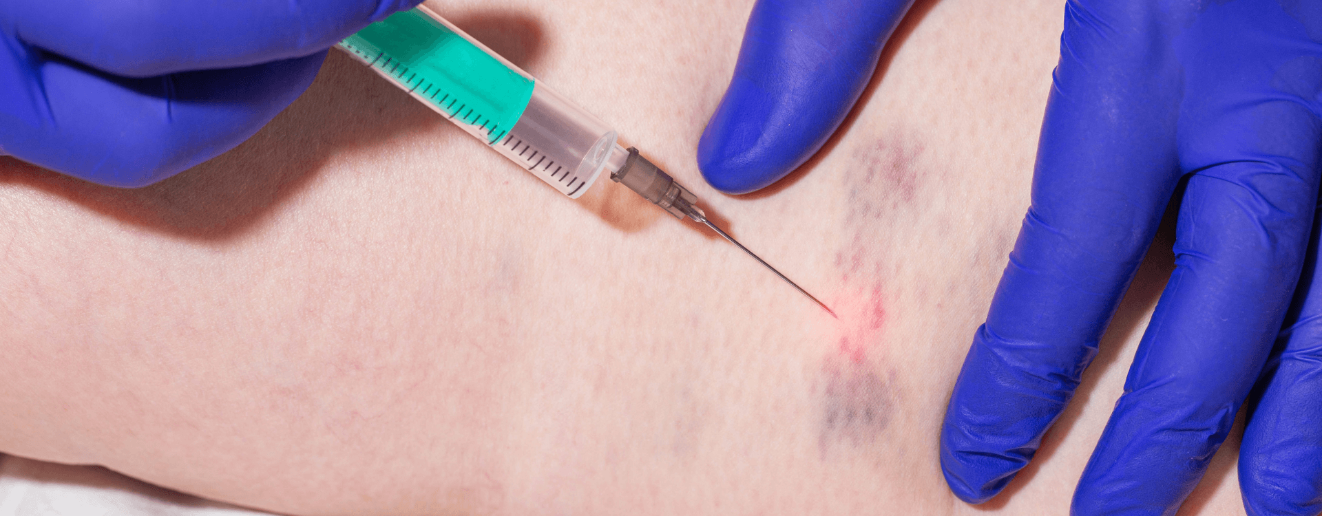 Sclerotherapy procedure: healthcare provider injecting a solution into leg veins to reduce spider and varicose veins at Montville MedSpa.