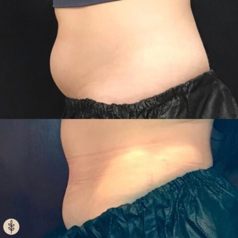 Before and after: coolsculpting