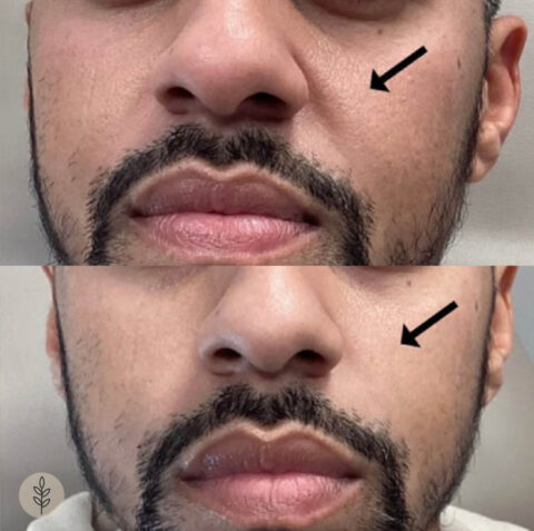 Before and after: dermal filler, nasolabial folds