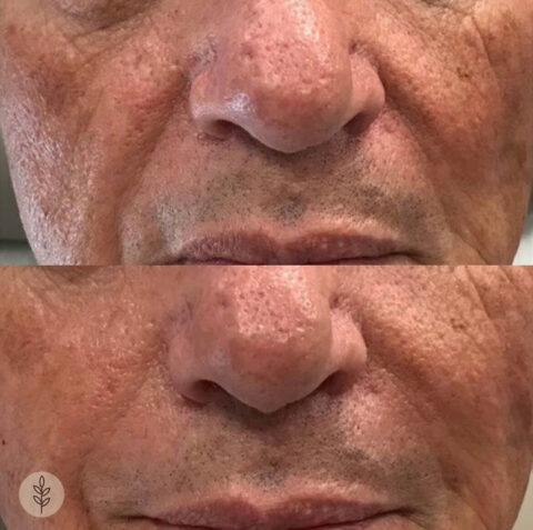 Before and after: dermal filler, nasolabial folds