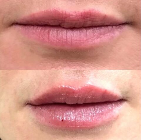 Before and after: lip filler