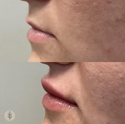 Before and after: lip filler