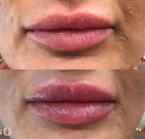 Before and after: lip filler
