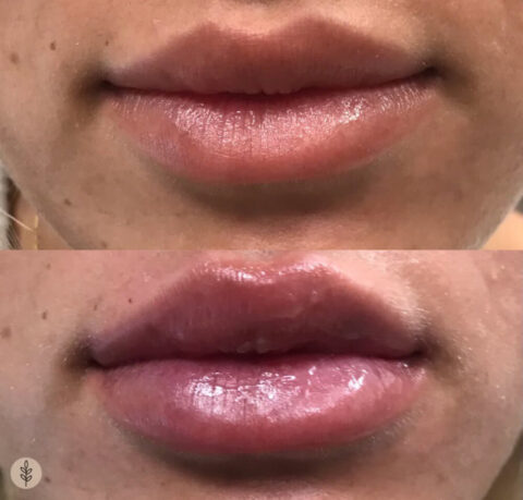 Before and after: lip filler