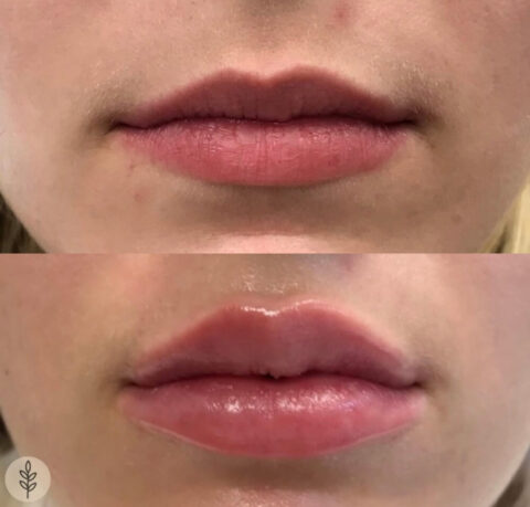 Before and after: lip filler