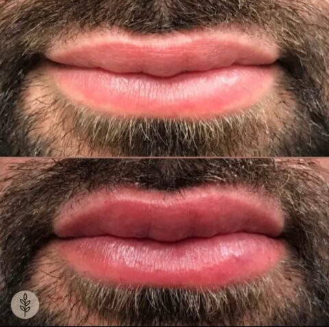 Before and after: lip filler