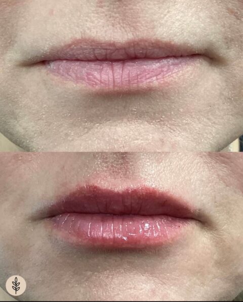 Before and after: lip filler