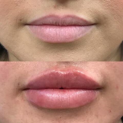 Before and after: lip filler