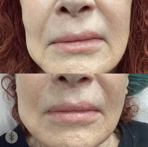 Before and after: pdo thread lift