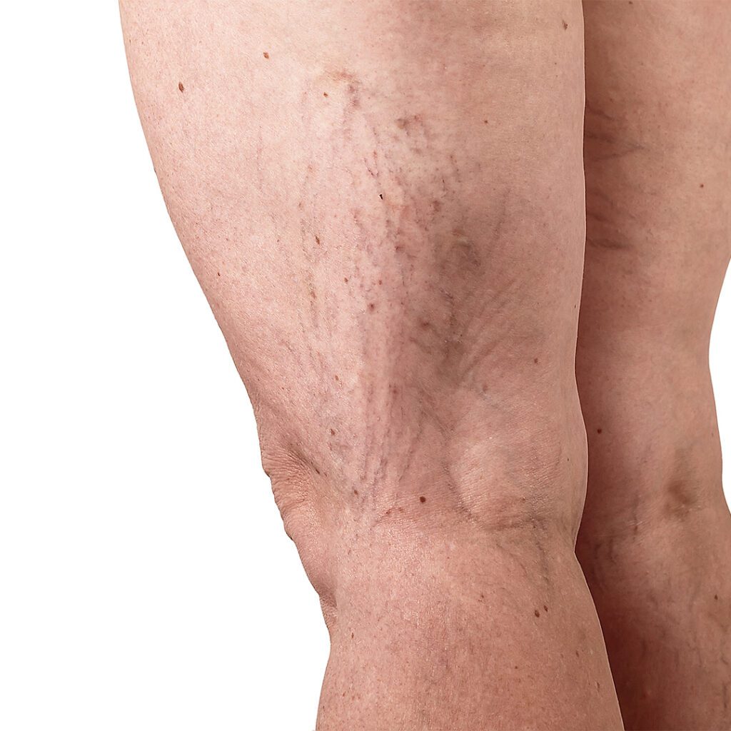 Varicose veins on the backs of a woman's legs