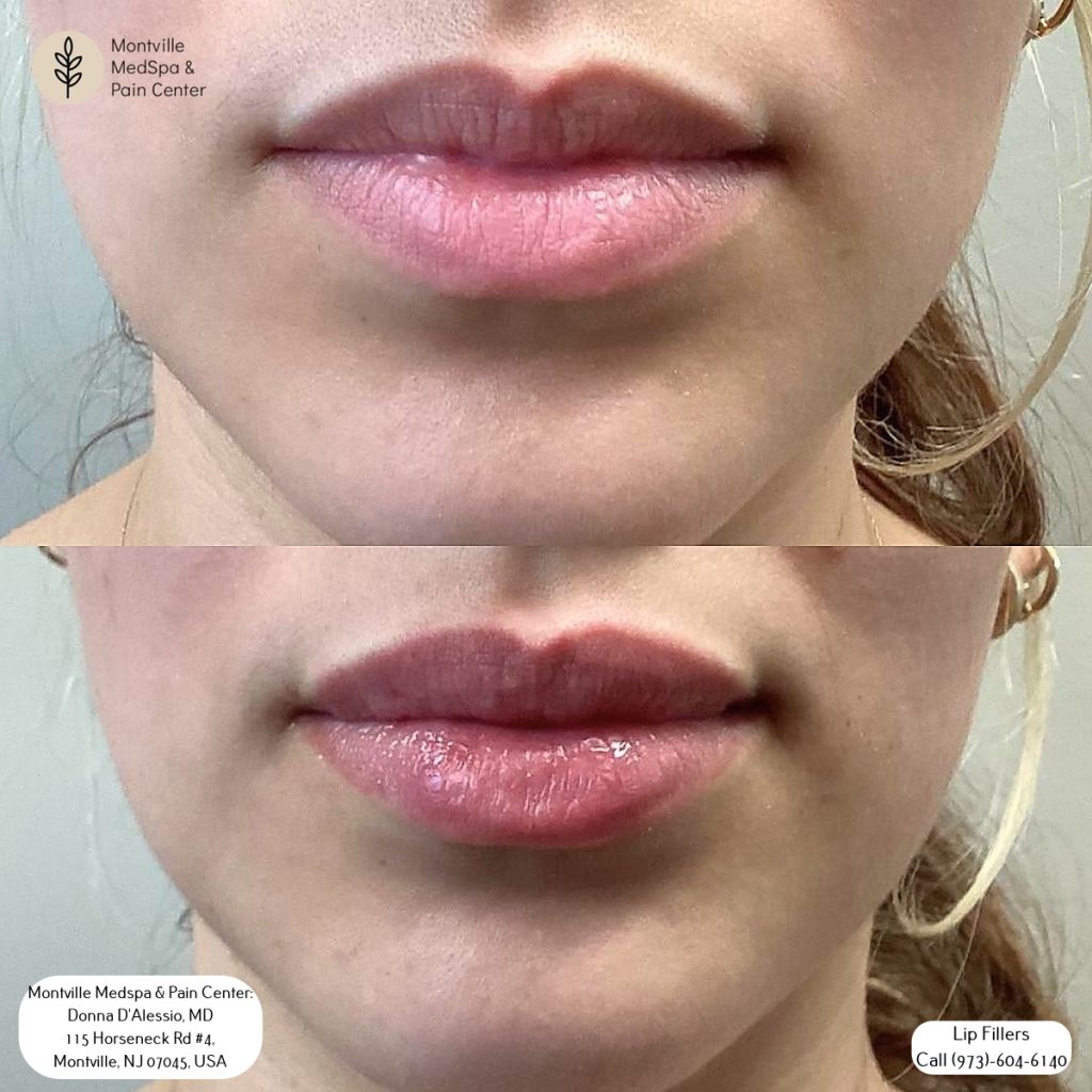 lip filler treatments at Montville MedSpa