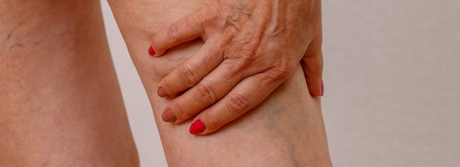 Varicose veins on the back of a woman's leg