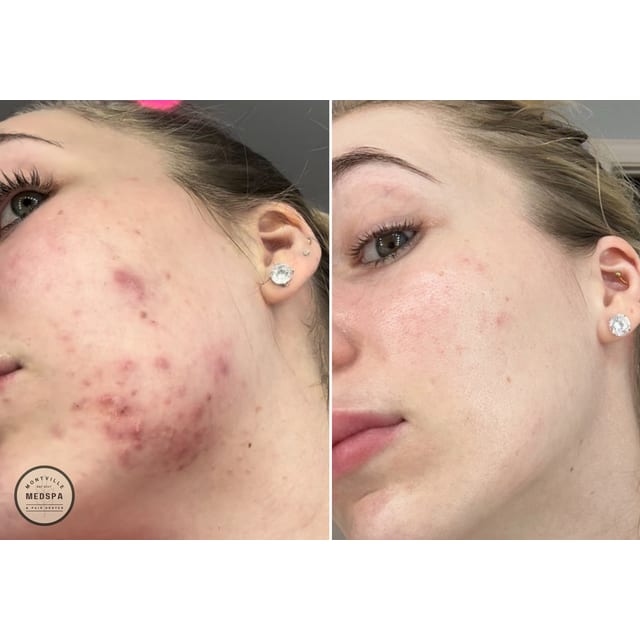 Before and after: acne transformation