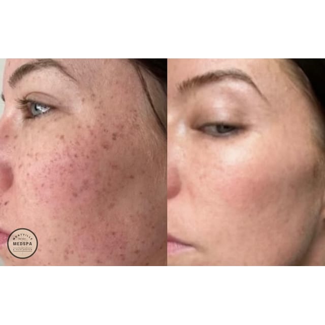 Before and after: bbl