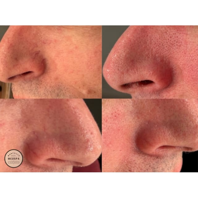 Before and after: bbl for broken capillaries