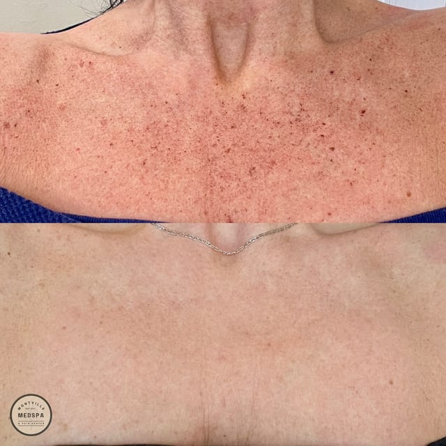 Before and after: bbl / moxi – after 1 treatment