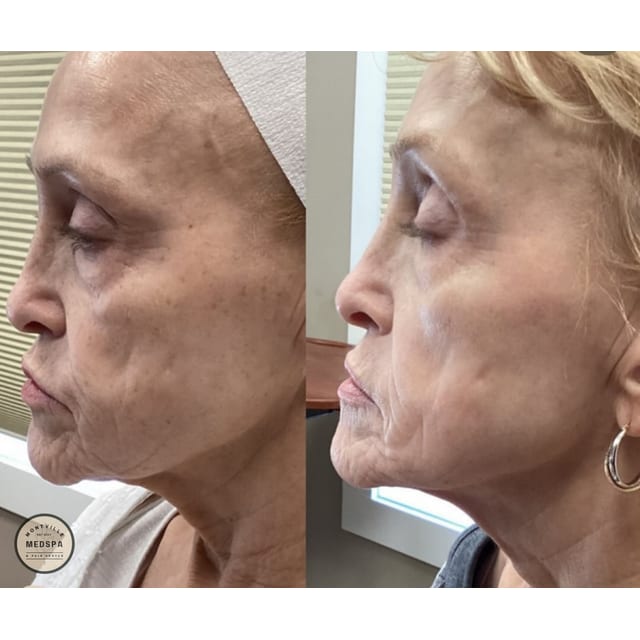 Before and after: bbl / moxi – after 1 treatment