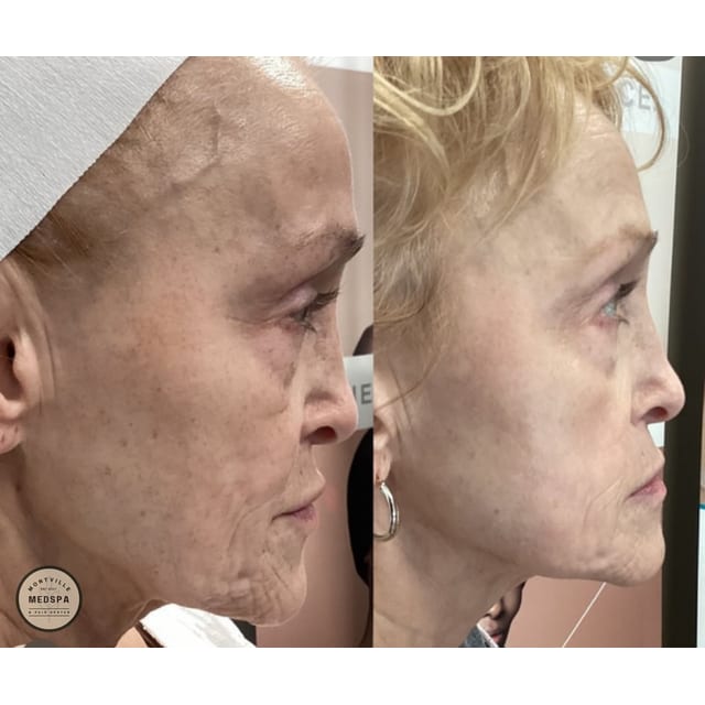 Before and after: bbl / moxi – after 1 treatment