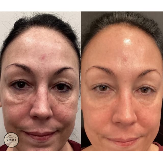 Before and after: bbl / moxi – after 1 treatment