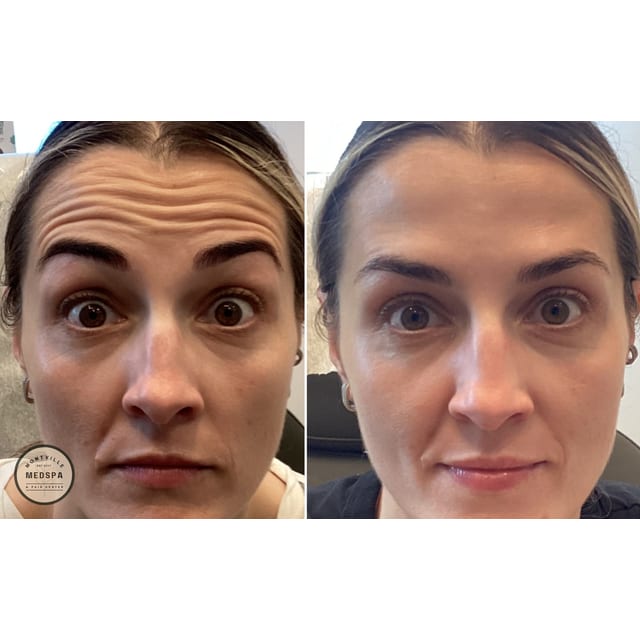 Before and after: botox