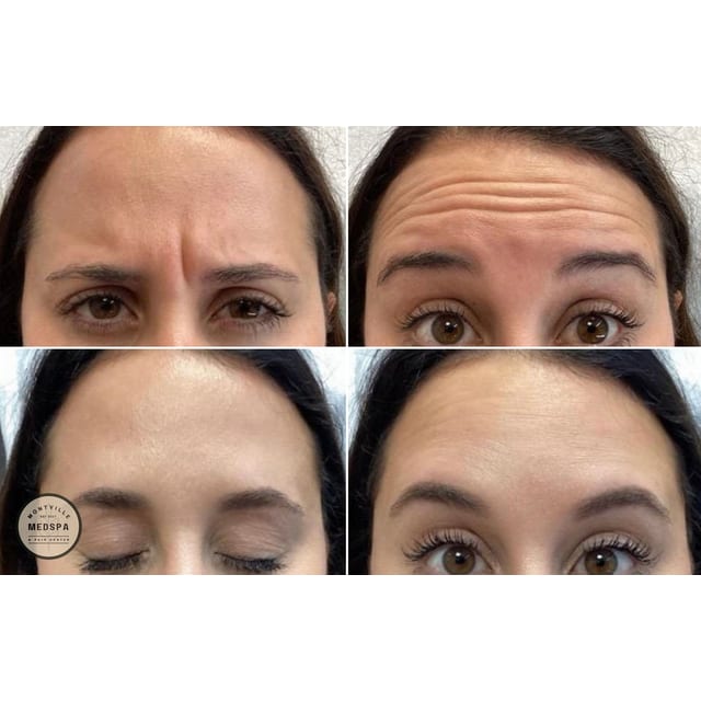 Before and after: botox