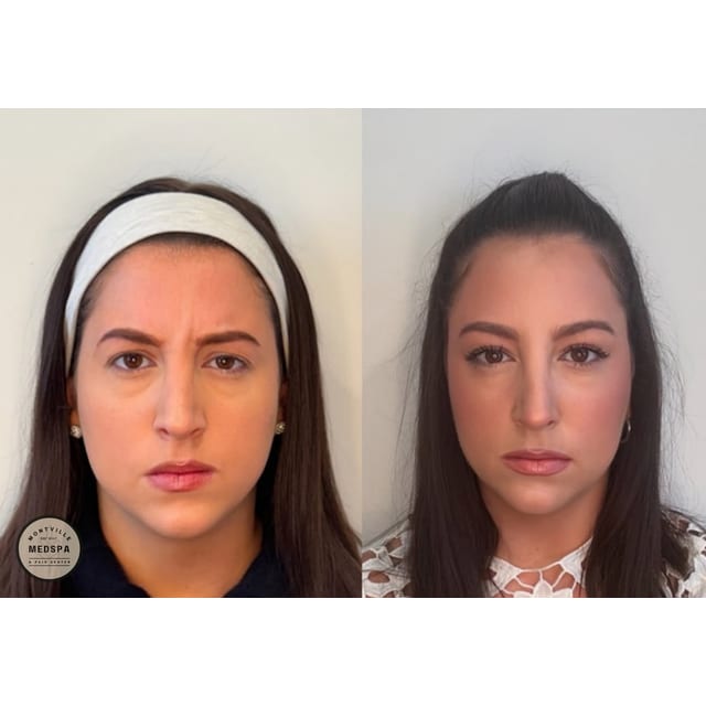 Before and after: botox