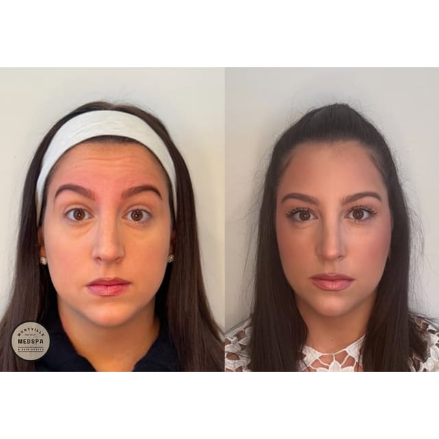 Before and after: botox
