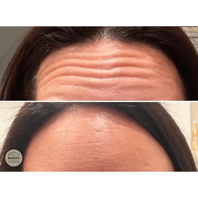 Before and after: botox