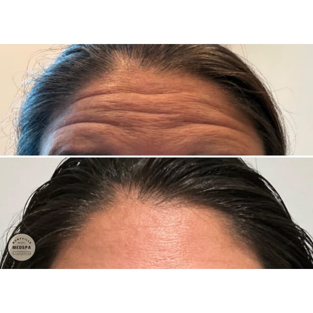 Before and after: botox
