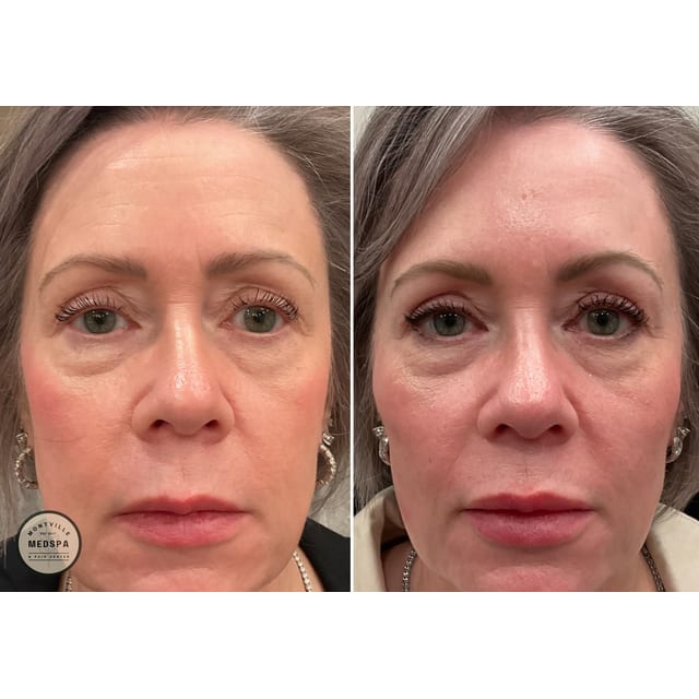 Before and after: botox & filler