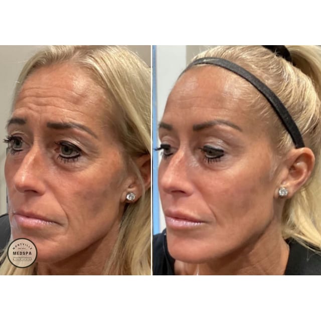 Before and after: botox & filler – full face