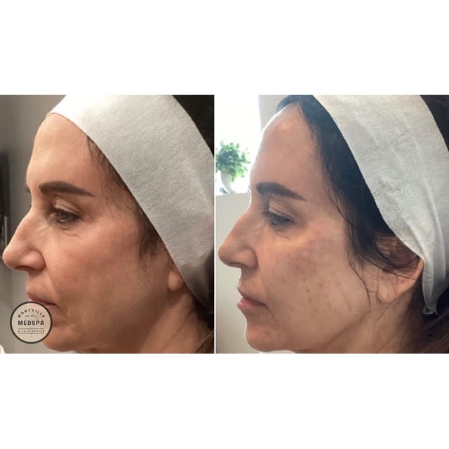 Before and after: botox, filler, radiesse & skinvive