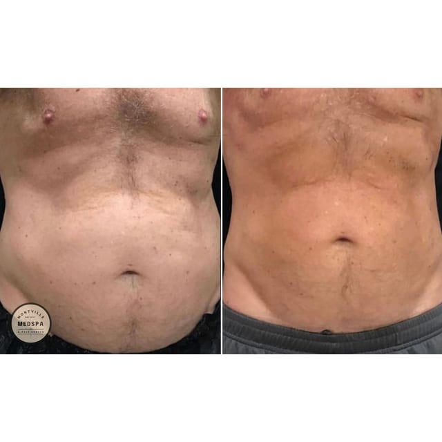 Before and after: coolsculpting