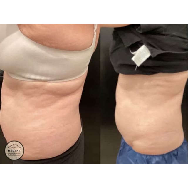 Before and after: coolsculpting