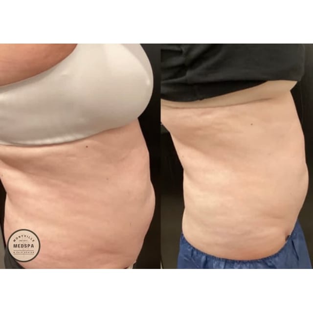 Before and after: coolsculpting