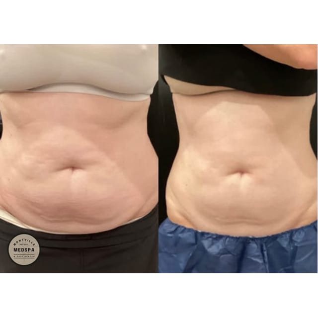 Before and after: coolsculpting