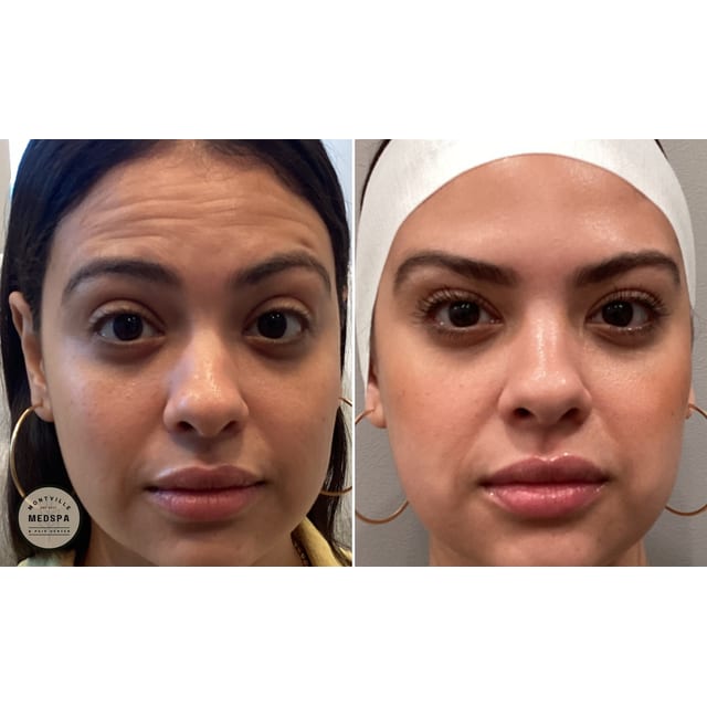 Before and after: dysport
