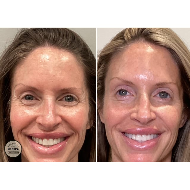 Before and after: dysport & skinvive