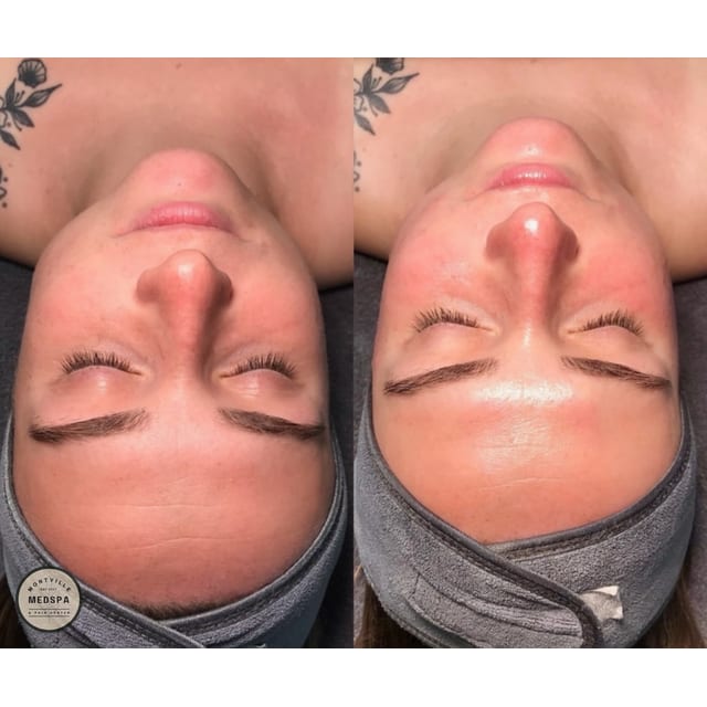 Before and after: facial with dermaplaning