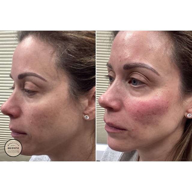 Before and after: filler – cheeks