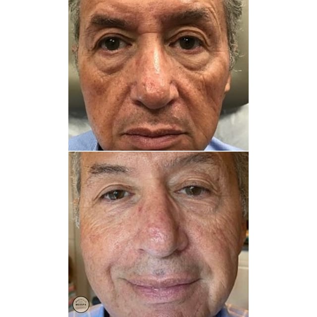 Before and after: filler – cheeks