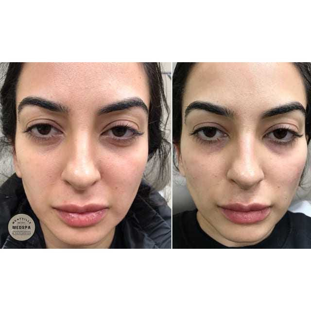 Before and after: filler – cheeks