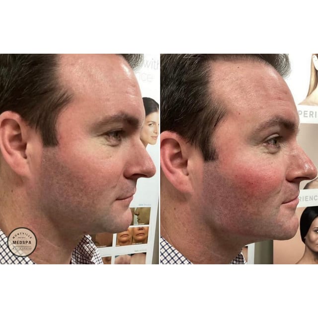 Before and after: filler – cheeks, chin & jawline