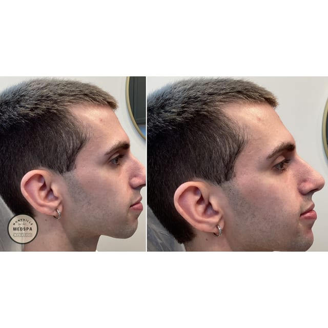 Before and after: filler – chin