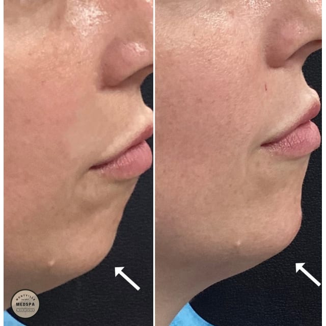 Before and after: filler – chin