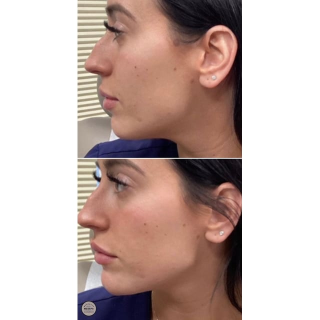 Before and after: filler – jawline