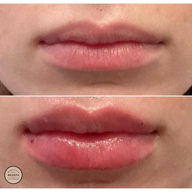 Before and after: filler – lips