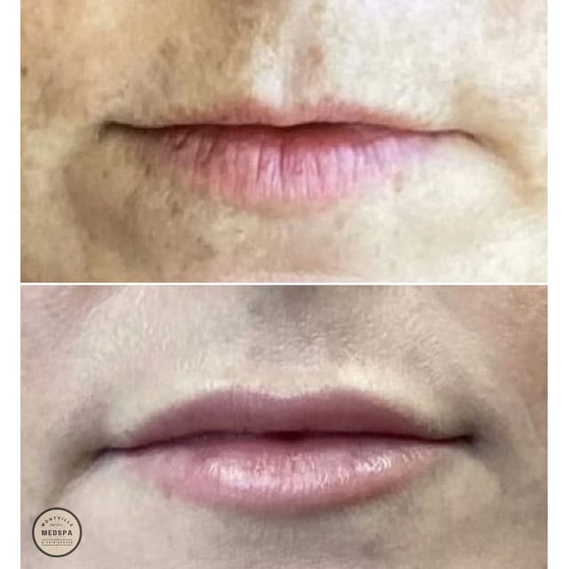 Before and after: filler – lips