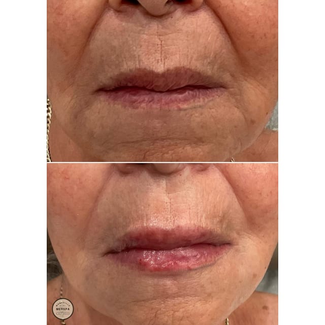 Before and after: filler – lips