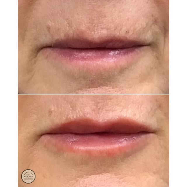 Before and after: filler – lips